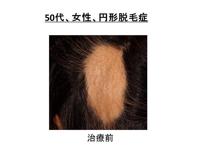 円形脱毛症　病院